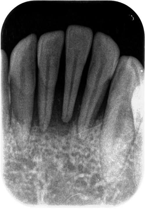 歯周病症例