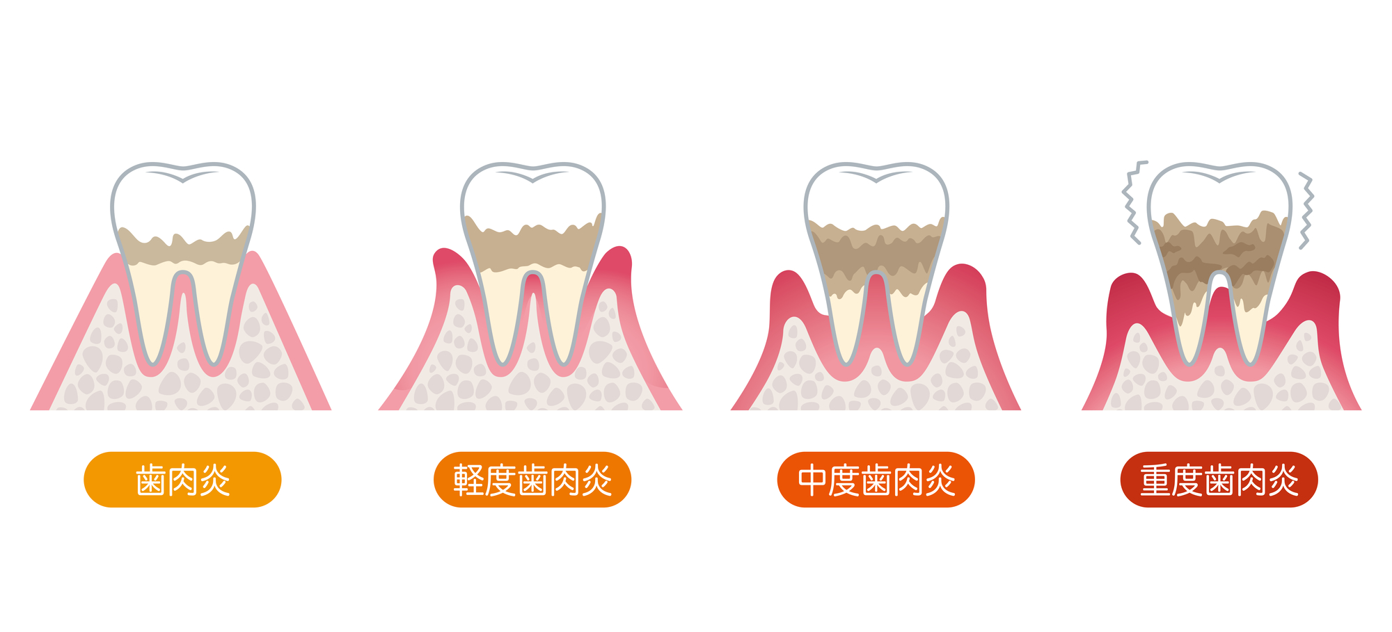 マタニティ歯科｜歯周病